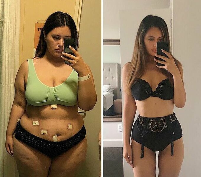 Chica antes y después de la pérdida de peso con cápsulas KETO Complete